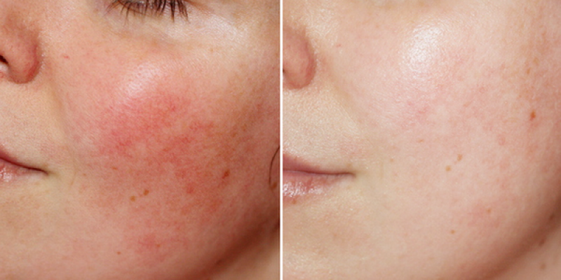 Bí quyết chăm sóc da nhạy, cảm tổn thương: Giải pháp hiệu quả với Azulene 80% & Elazulene Peptablue